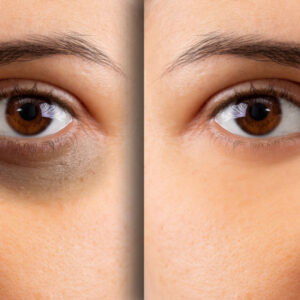 علاج الهالات السوداء – Dark Circles Treatment