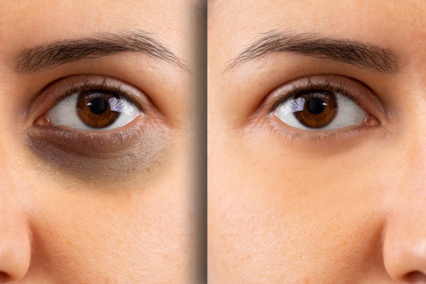 علاج الهالات السوداء – Dark Circles Treatment