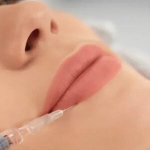 فيلر الشفايف – Lip Filler Treatment