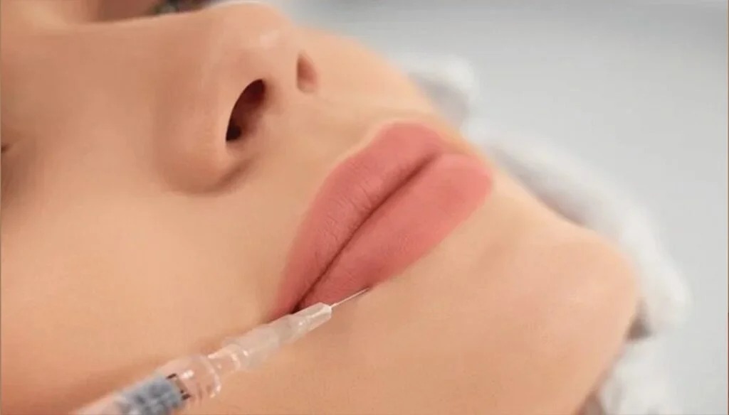 فيلر الشفايف – Lip Filler Treatment
