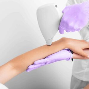 ازاله الشعر بالليزر