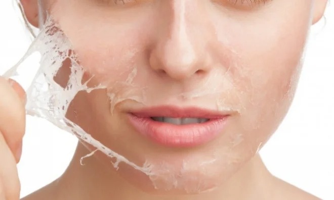 تقشير كيماوي