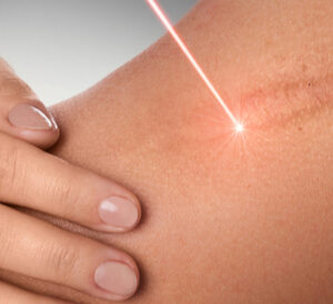 علاج الندبات – Scar Treatment