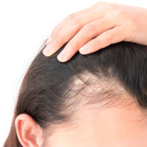 علاج الصلع الوراثي